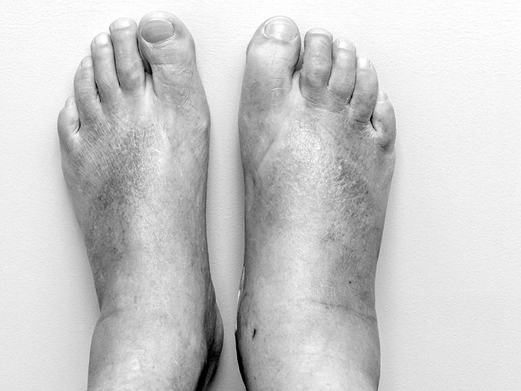 Swelling Ankles Feet Heart Failure