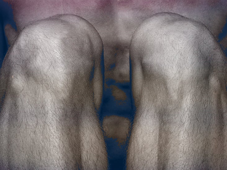 a térdízületek enyhítik a fájdalmat csípőízületi gyulladás