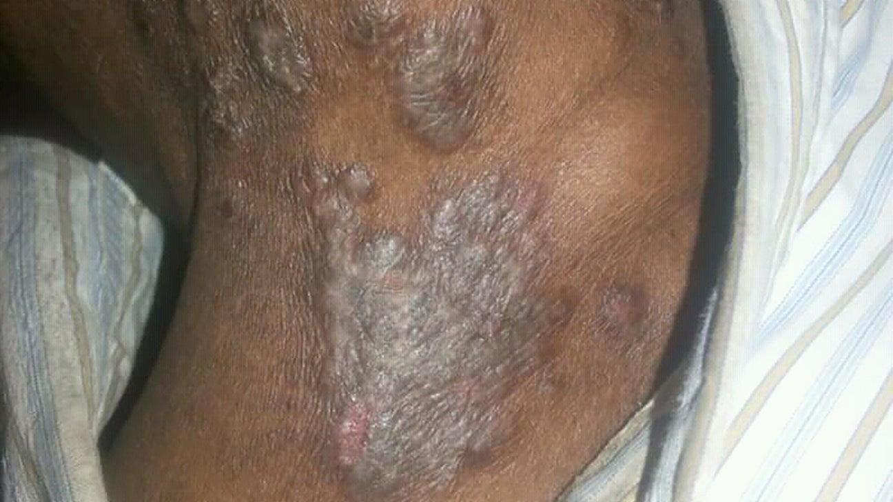 Does this look like scabies? I have a rash above my breast and just below  my panty line. My husband has small bumps on his thighs. : r/scabies