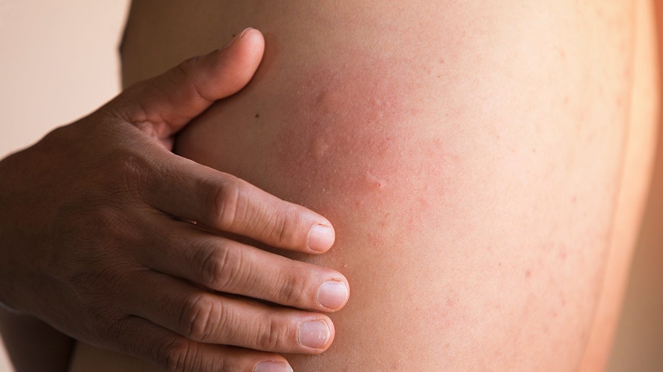 Raised Skin Bumps: Pictures, Types, Causes, and Treatment