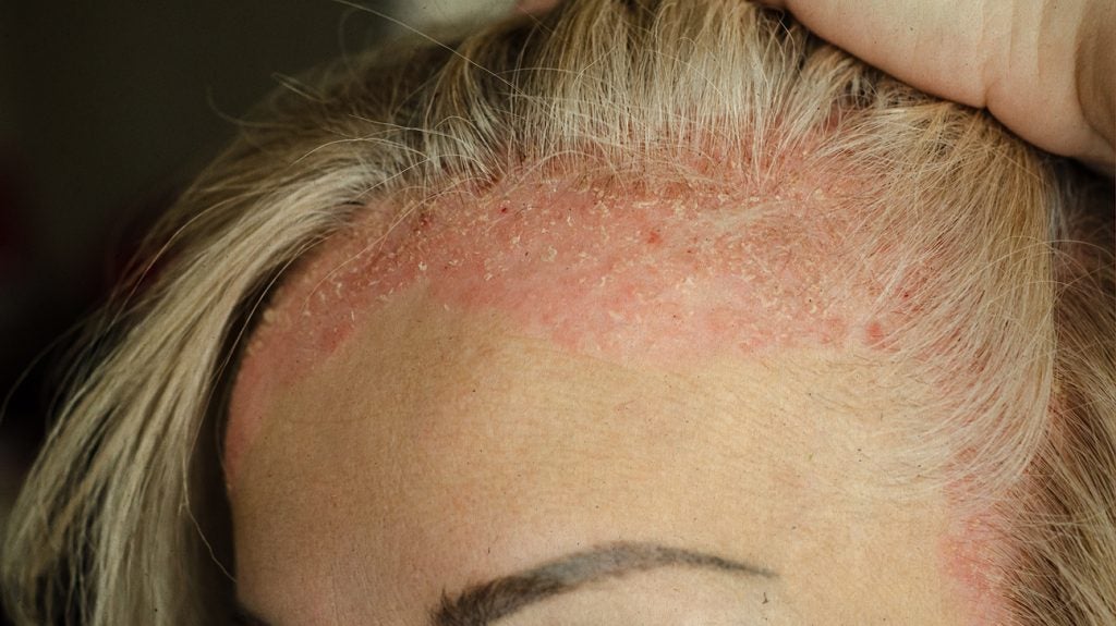 How to safely remove psoriasis patches on the skin