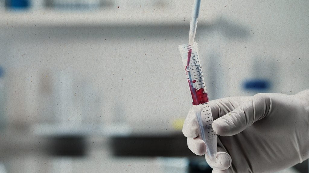 Tests For Diagnosing Rheumatoid Arthritis