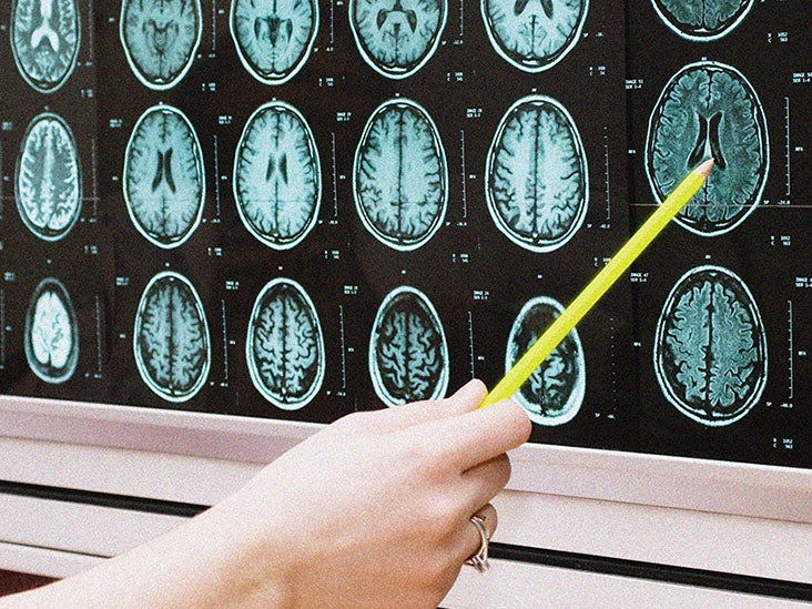 When Cancer Spreads to the Brain How Long to Live  