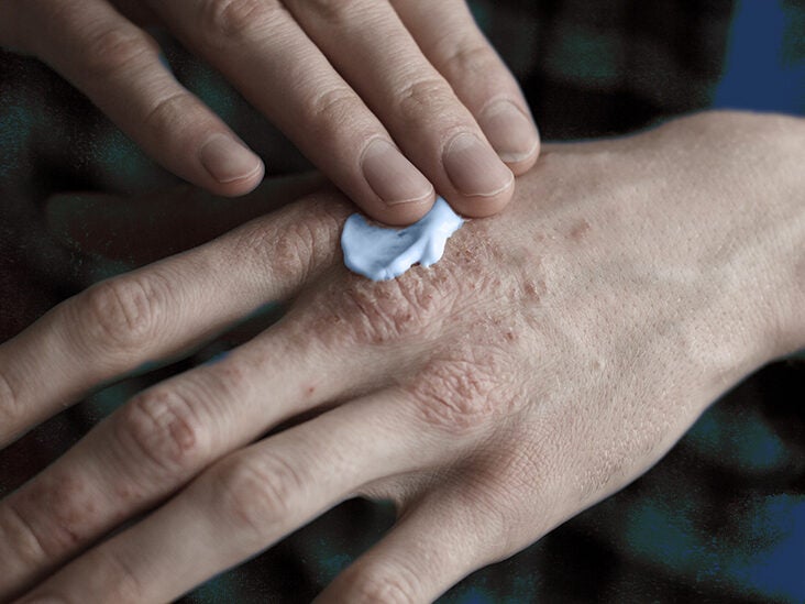 Psoriasis Rash Types Pictures And Symptoms