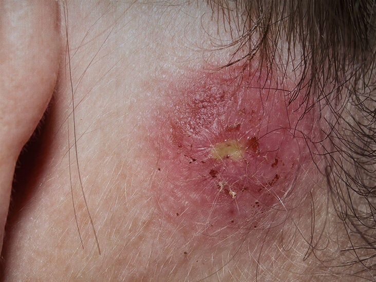 Staph infection: Types, symptoms, causes, treatments