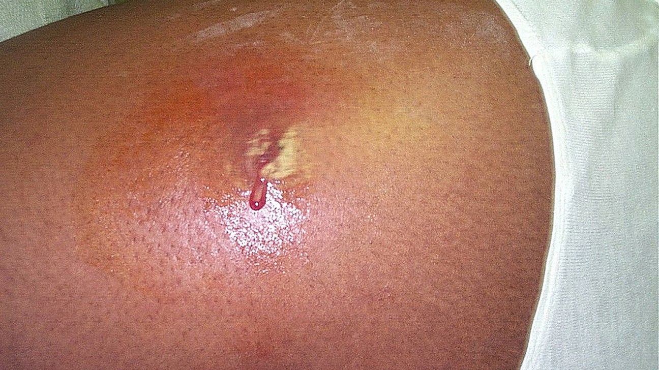 Ingrown hair and staph infection: Symptoms, causes, treatment