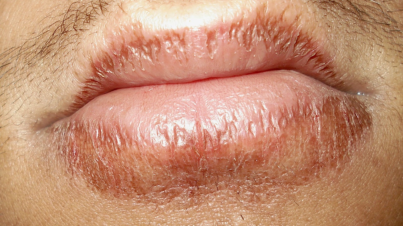 reaction lips: Causes, symptoms, treatment, and more