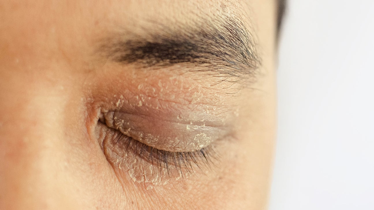 Dry skin around the eyes: Causes, treatment, and more