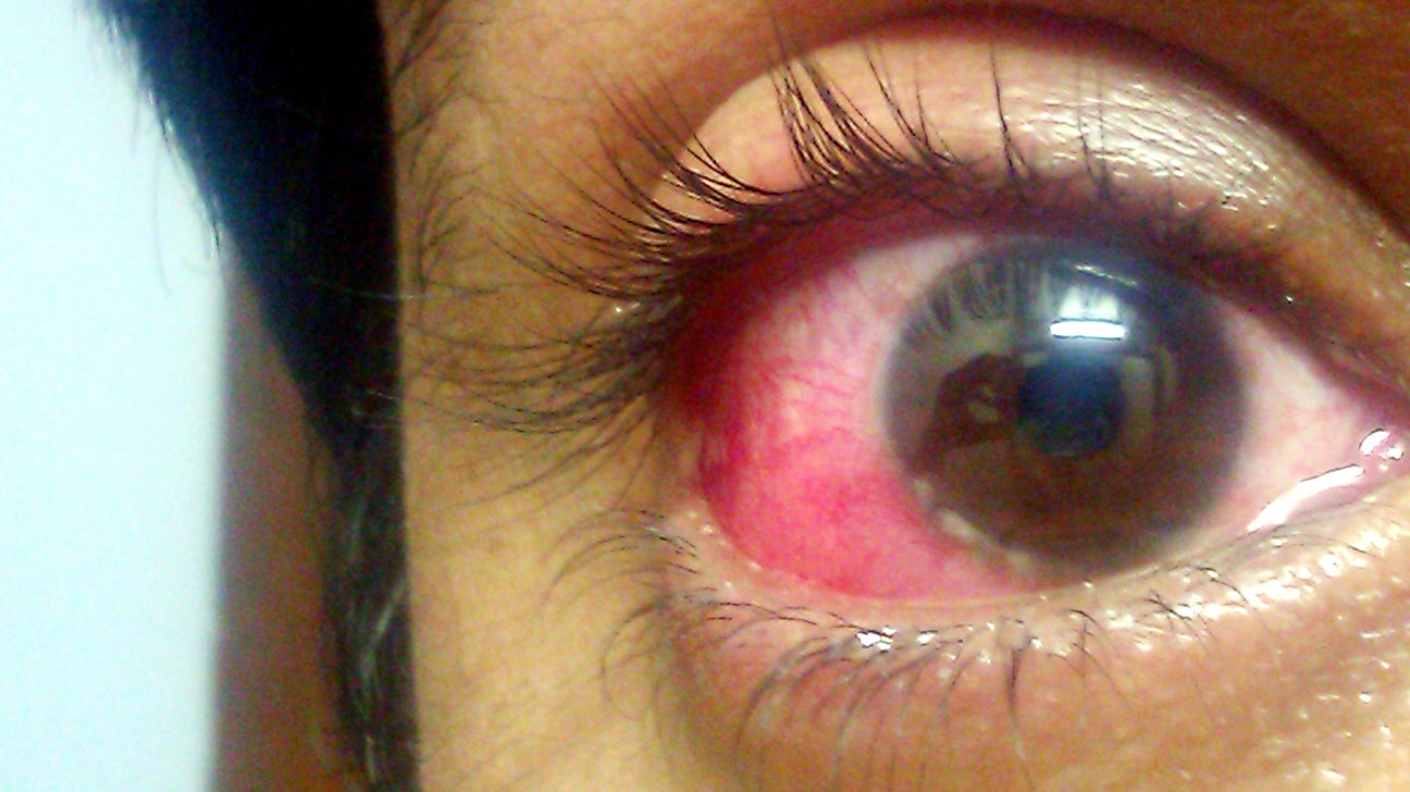 Dry Rash Under Eye Red Dry Skin Under Eyes