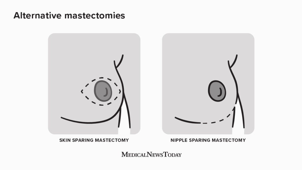Breast removal surgery double mastectomy. Medical illustration of