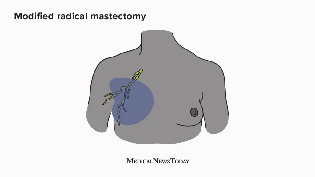 Mastectomy Types, uses, and procedure