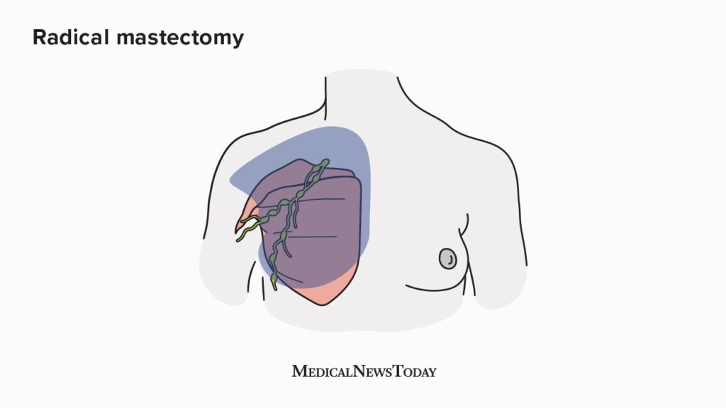 Radical Mastectomy: Definition, Procedure, And Recovery