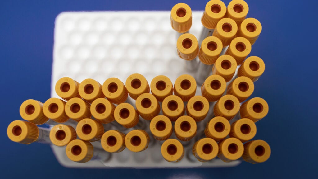 BNP test Ranges, results, and more