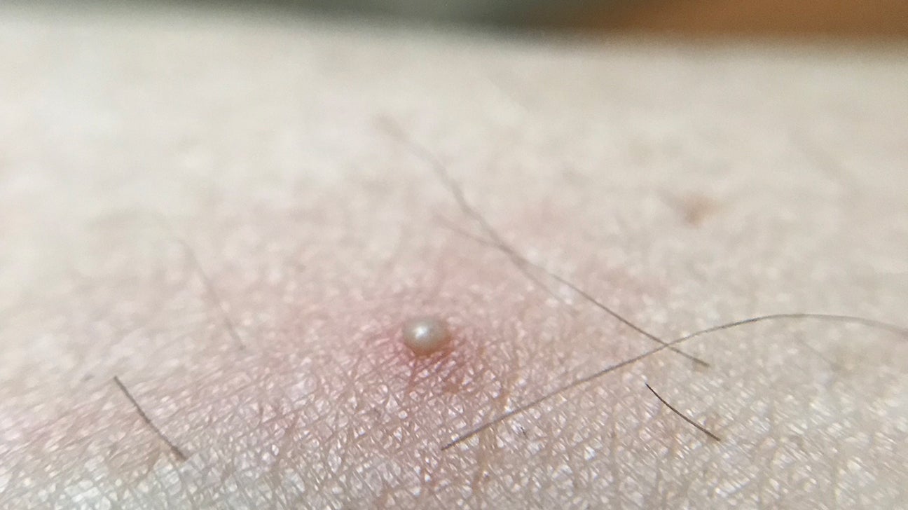 Ingrown Hair Cyst Symptoms Treatment Prevention and More