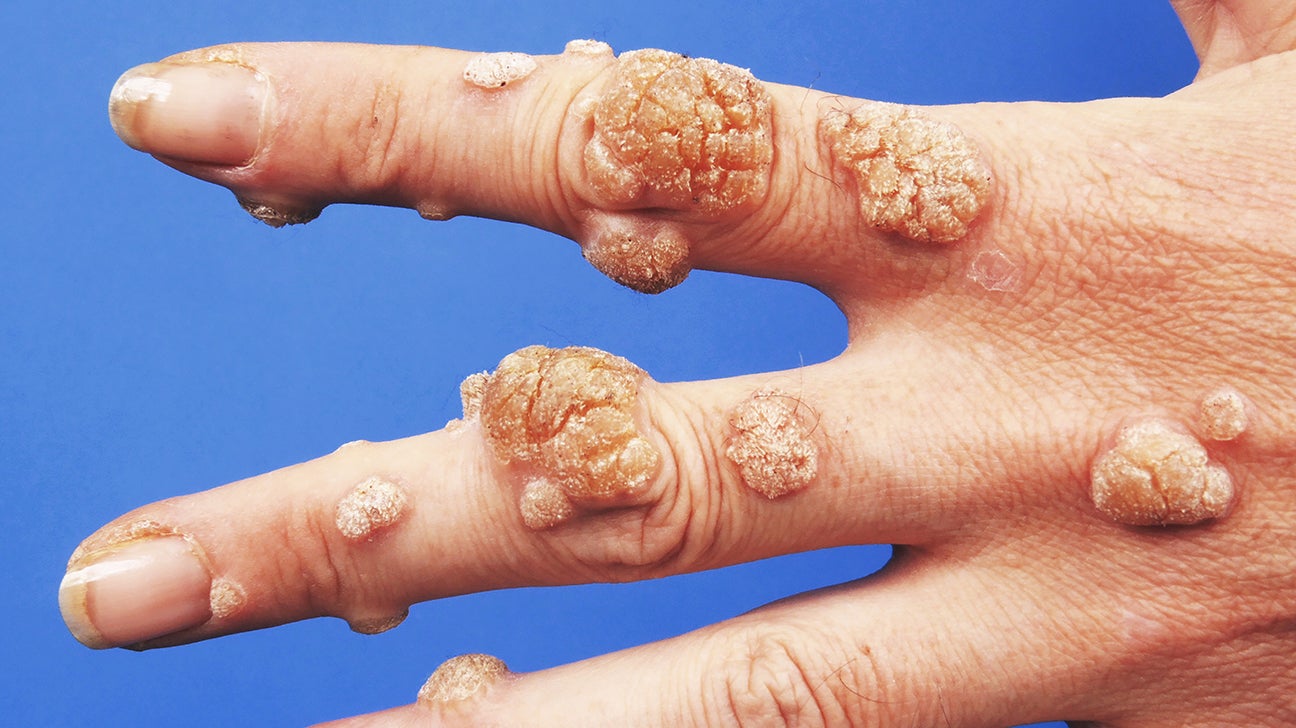 different bacteria on hands