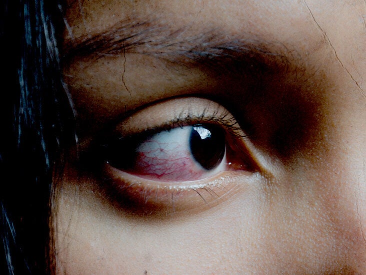 Syd hektar Natur Red eyes: List of common causes