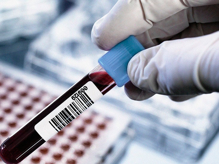 Rheumatoid Factor: Ranges, Tests, And Treatment