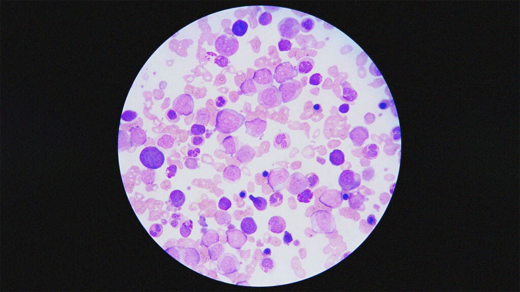 Acute myeloid leukemia (AML) morphology: What to know