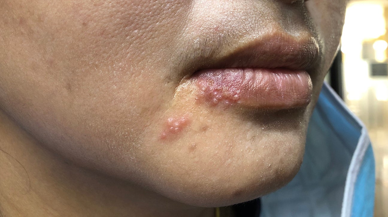 Fungal Rash On Face