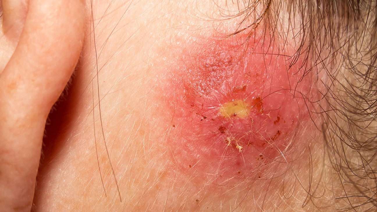 Staph Infection: Symptoms, Diagnosis, Treatment, and More