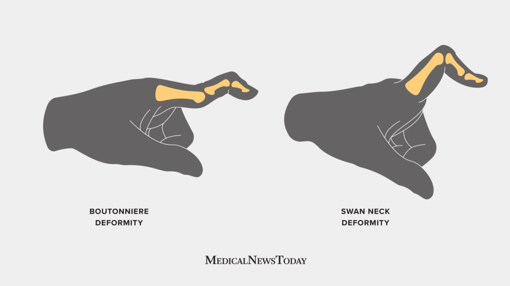 Swan neck deformity: Causes and treatment