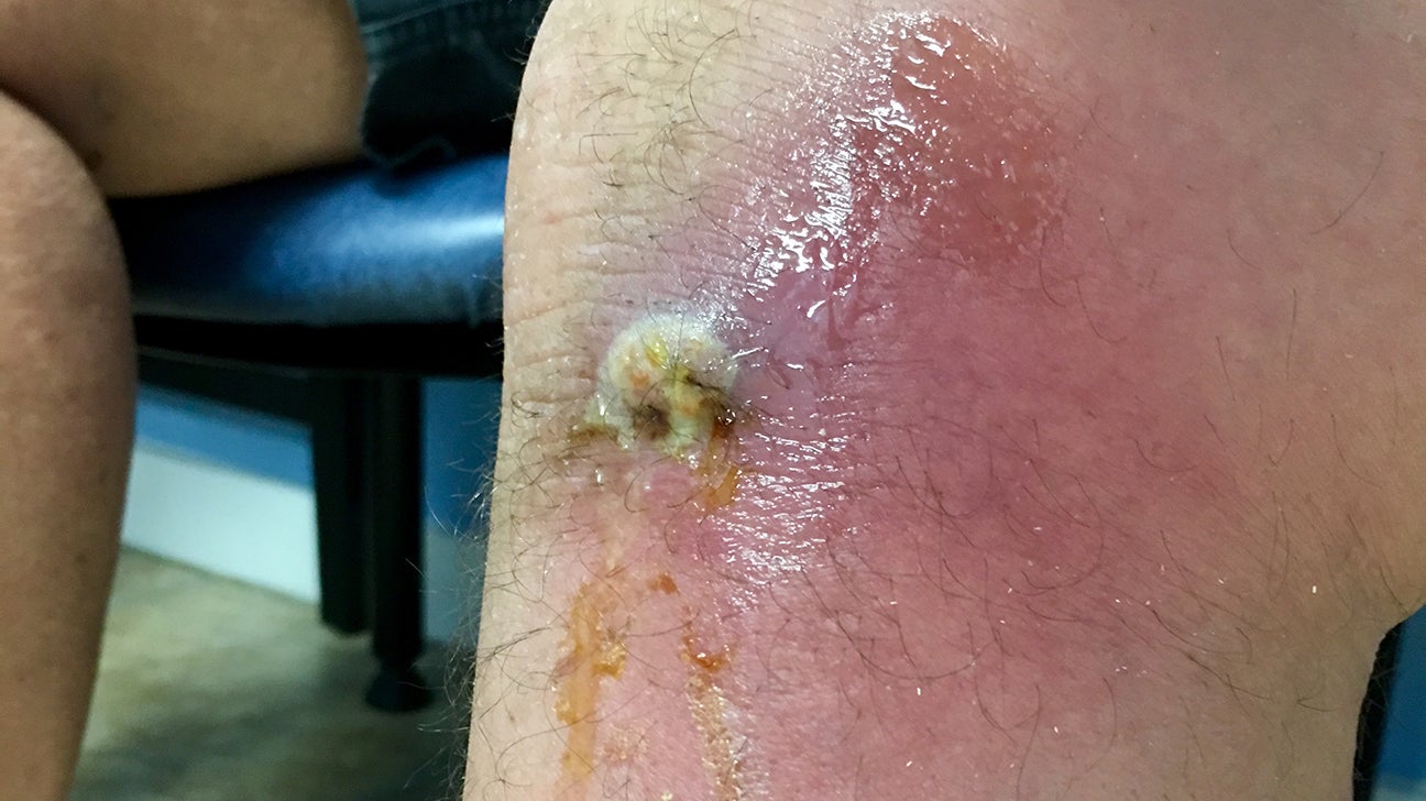 What is the Difference Between Spider Bite and Staph Infection