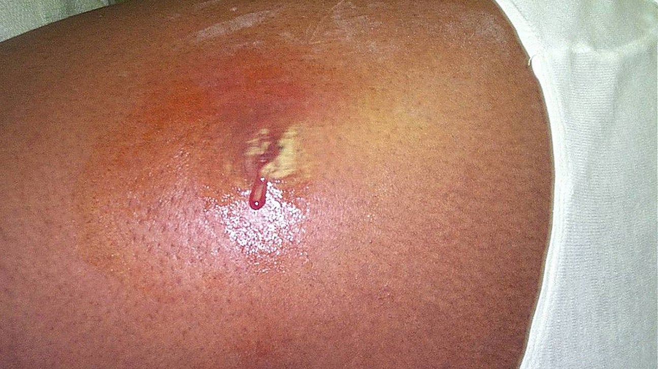 What is the Difference Between Spider Bite and Staph Infection