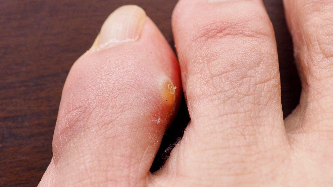 Calluses on the feet: how to get rid of the horn?