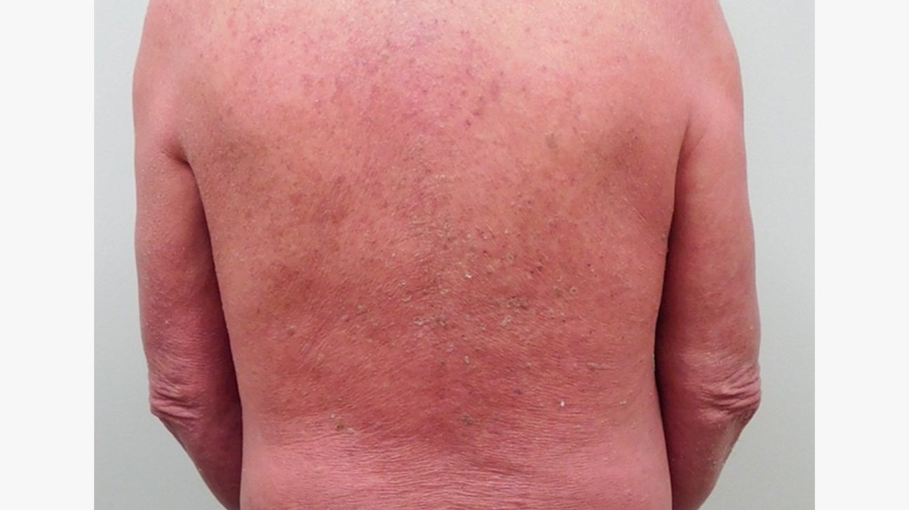 Psoriasis Pictures Signs And Symptoms 54 OFF