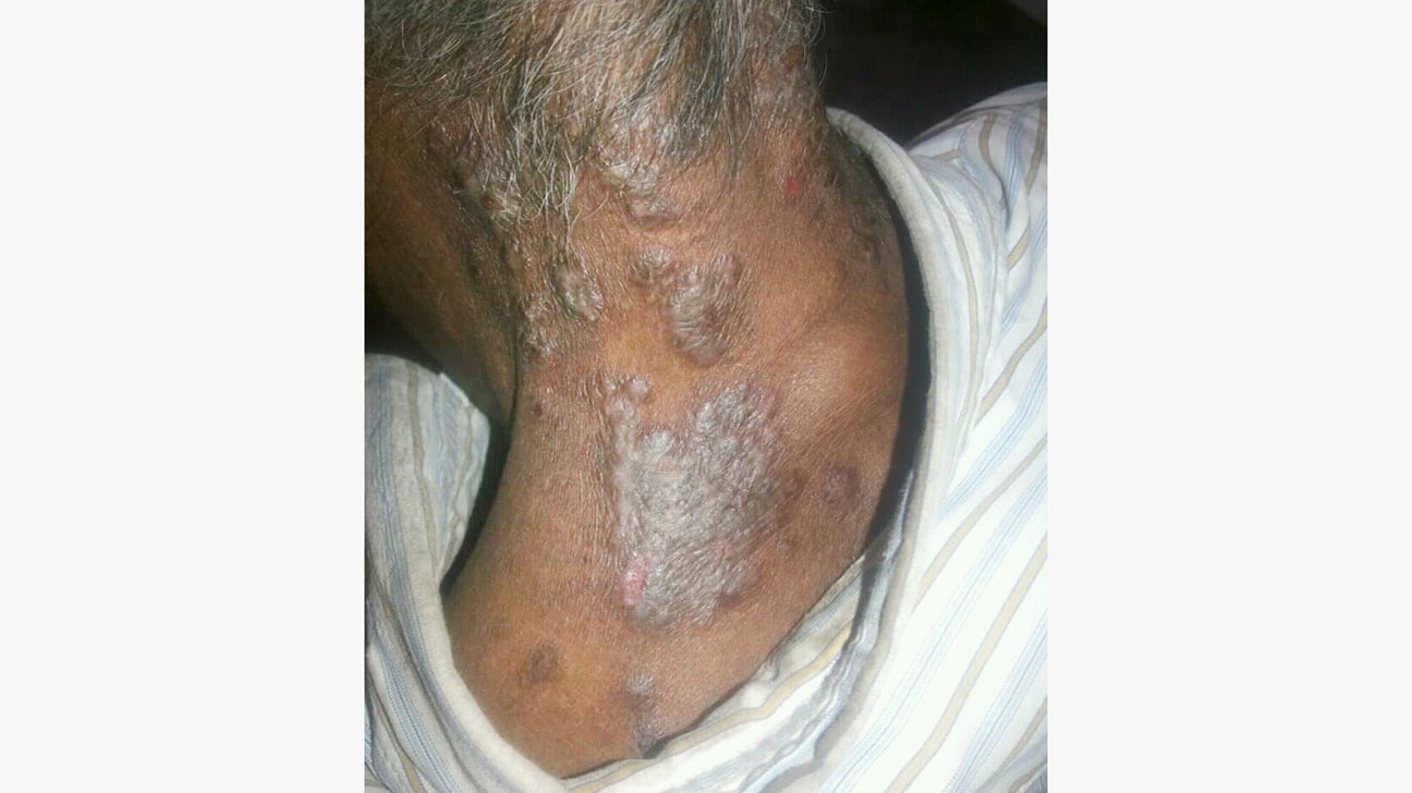 Psoriasis Specialist Raleigh Nc