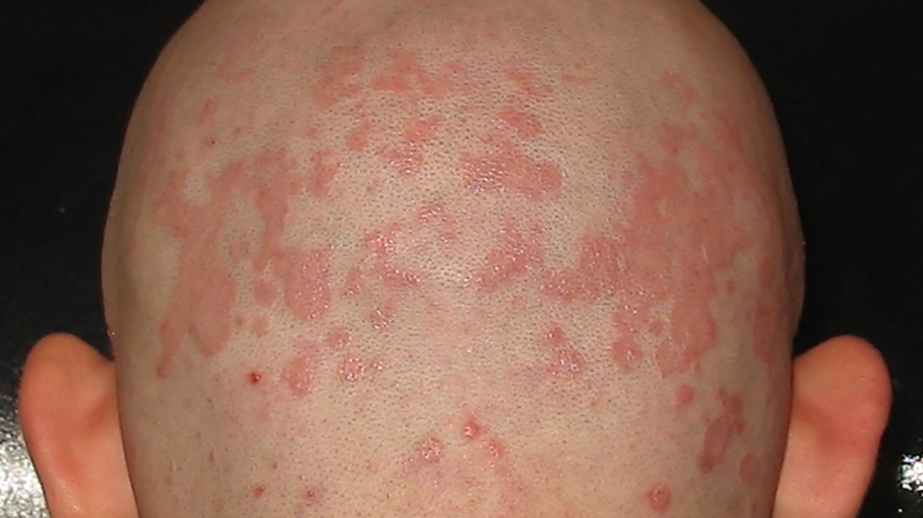 Seborrheic Dermatitis Raleigh Nc