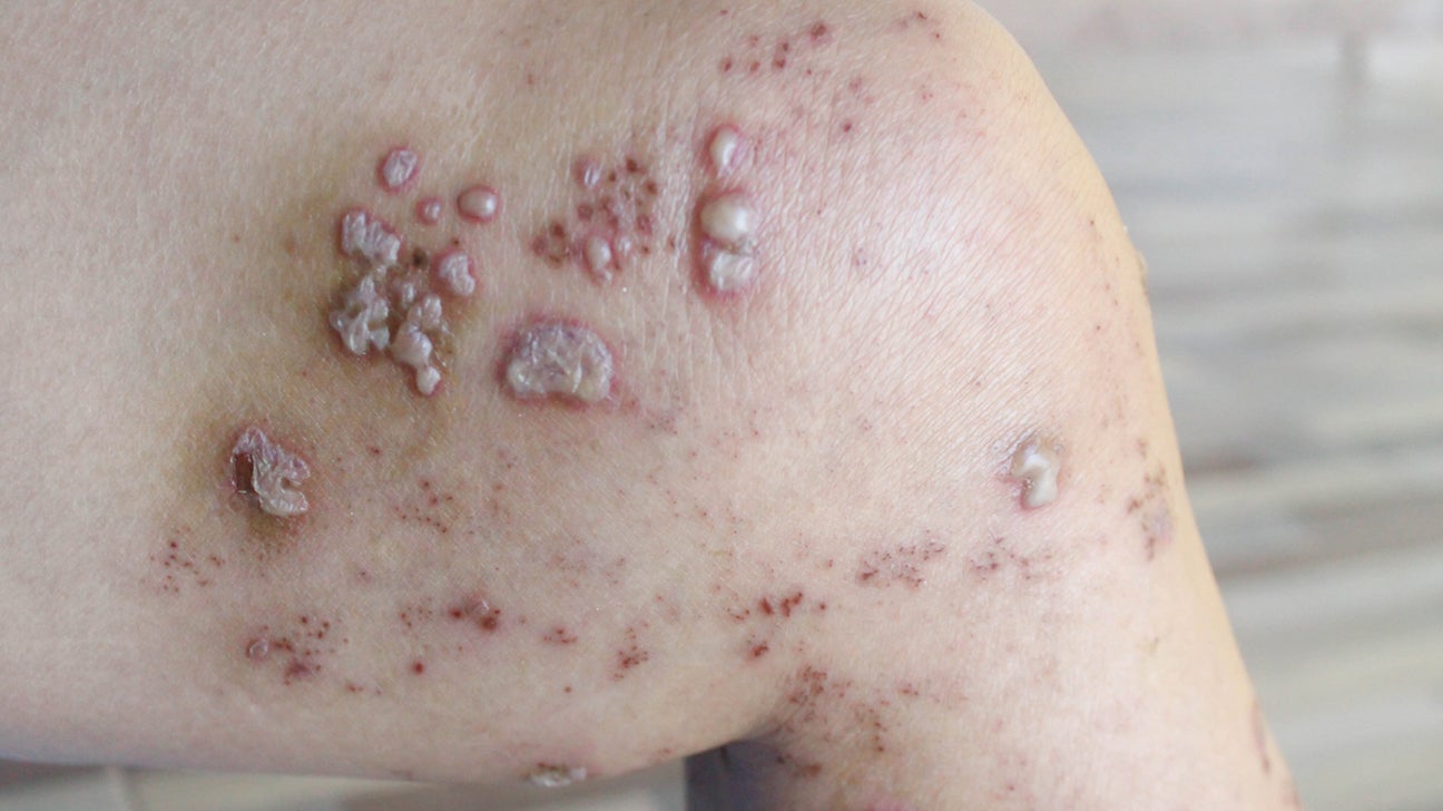 4 Common Skin Diseases and Conditions in Adults