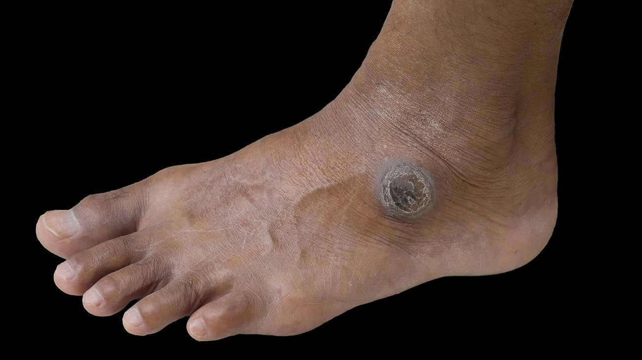 circular-callus-on-foot-hotsell-emergencydentistry