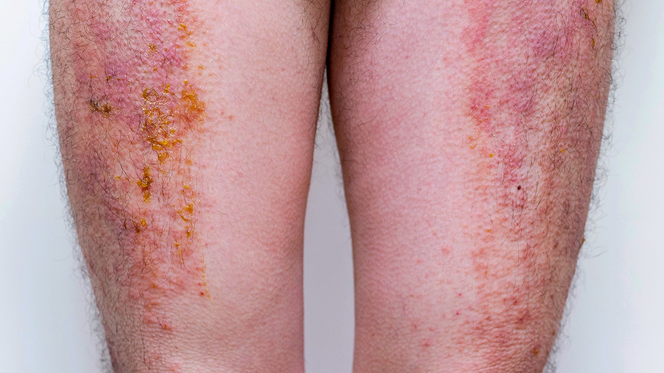 skin diseases)