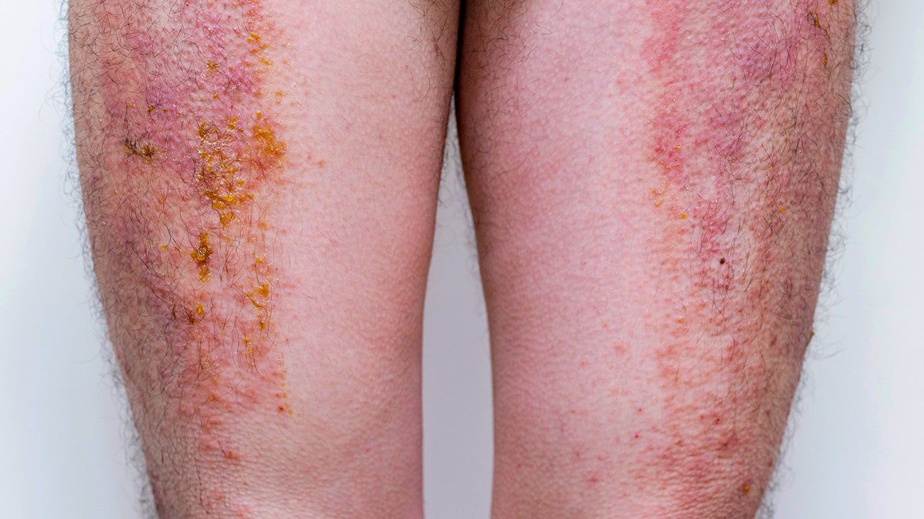 Prevention Tips for 5 Common Skin Rashes