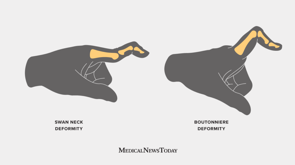 Swan Neck Deformity Causes And Treatment