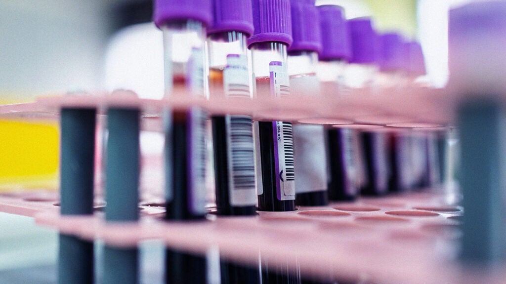 Can undetectable HIV detectable? What to know