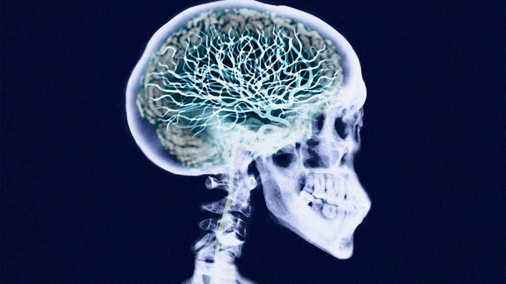 multiple-sclerosis-ms-seizures-causes-and-treatment