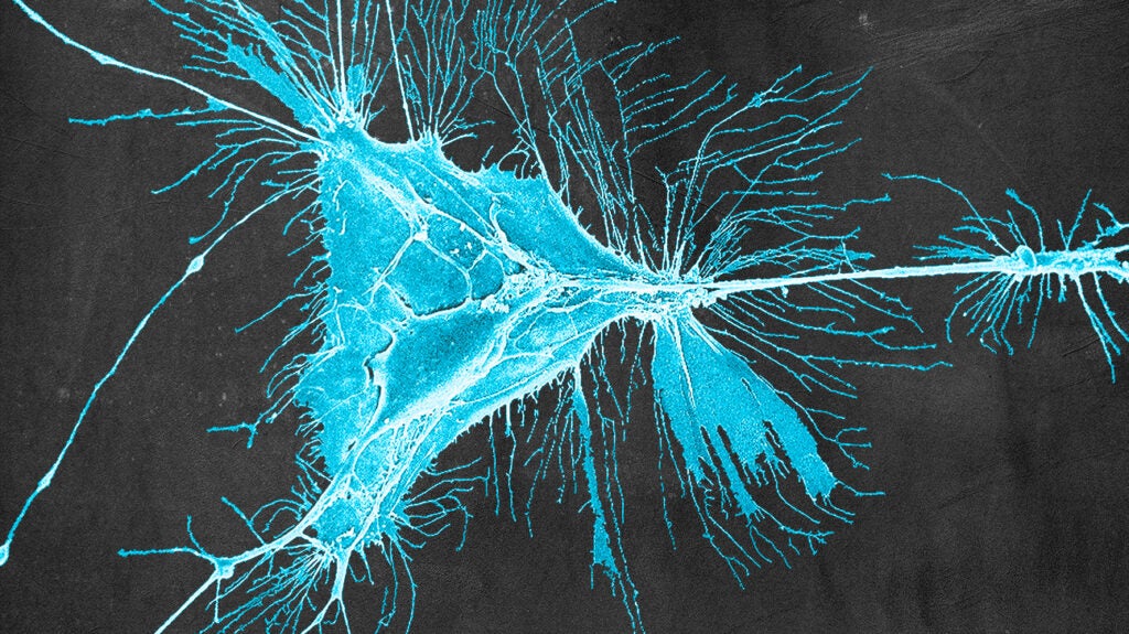 what-to-know-about-primary-central-nervous-system-lymphoma