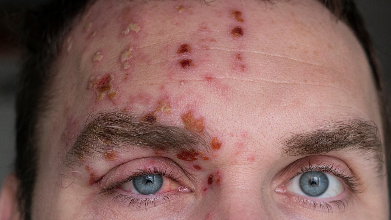 Shingles: Symptoms, treatment, and causes