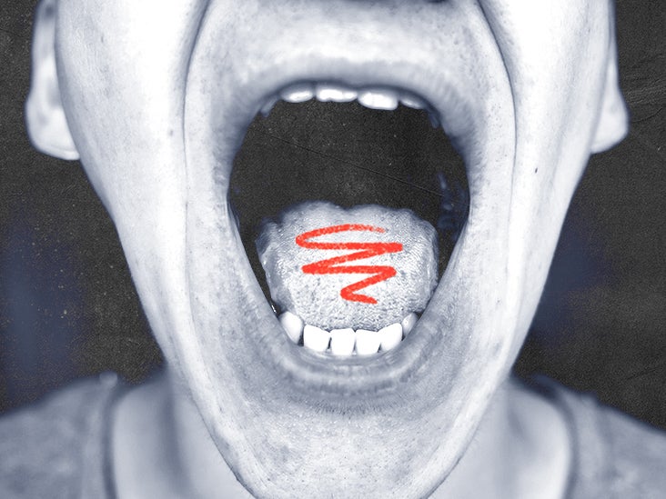 what-causes-acid-bumps-on-tongue-images-and-photos-finder