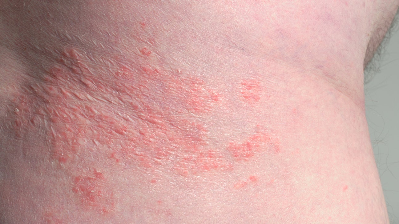 Eczema on the Symptoms, treatment, and prevention