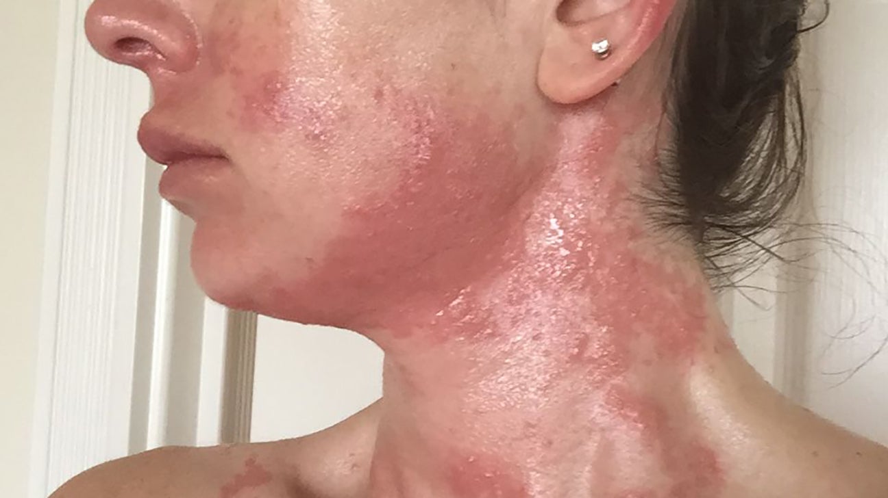 eczema on neck
