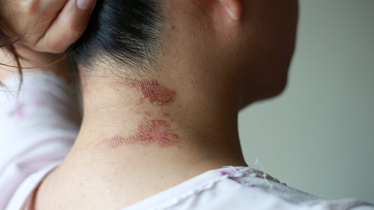 itchy rash back of neck