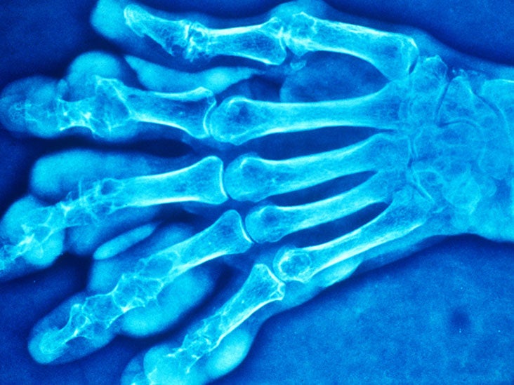 Can a person get gout in their hands?