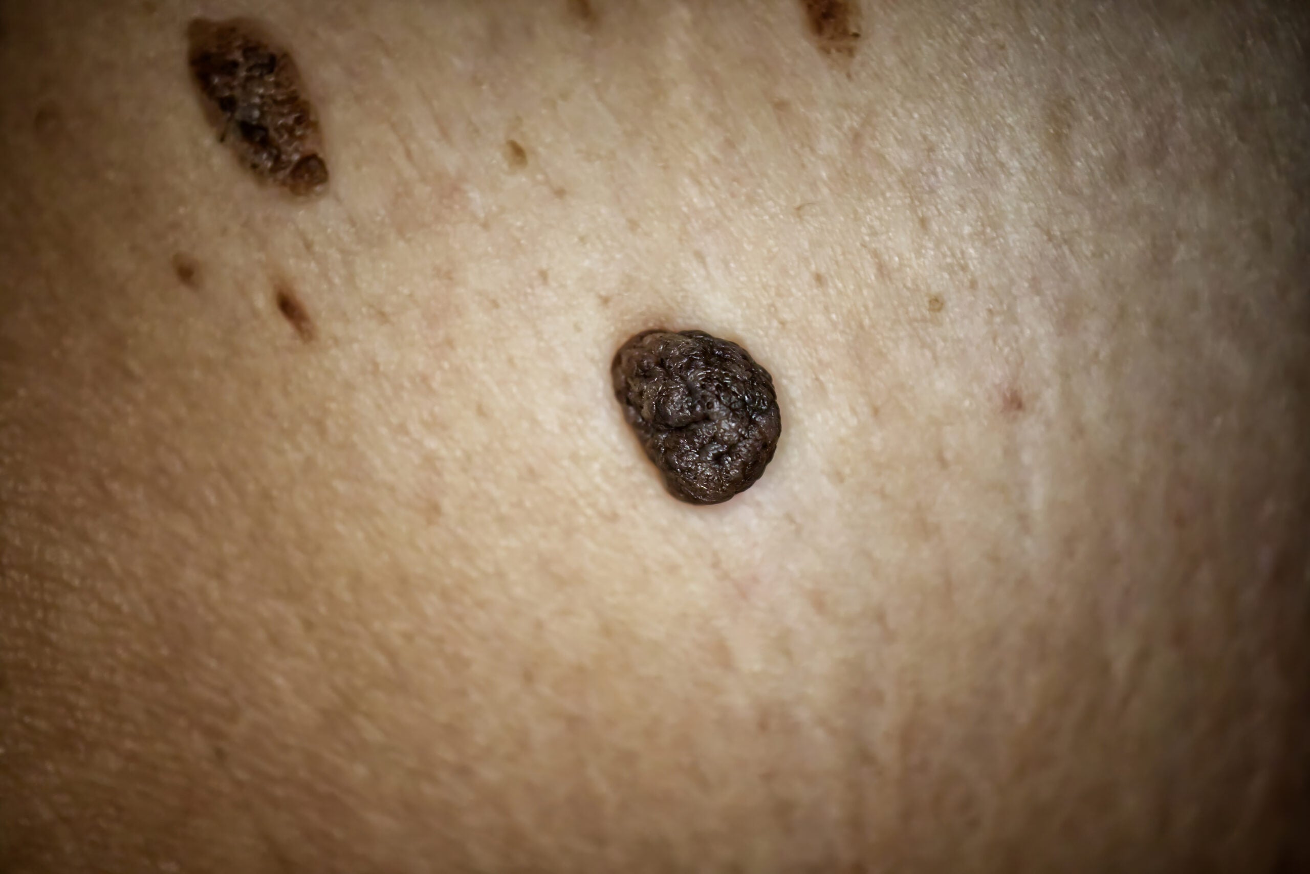 Recolectar 118 Images Skin Cancer Black Mole Viaterramx