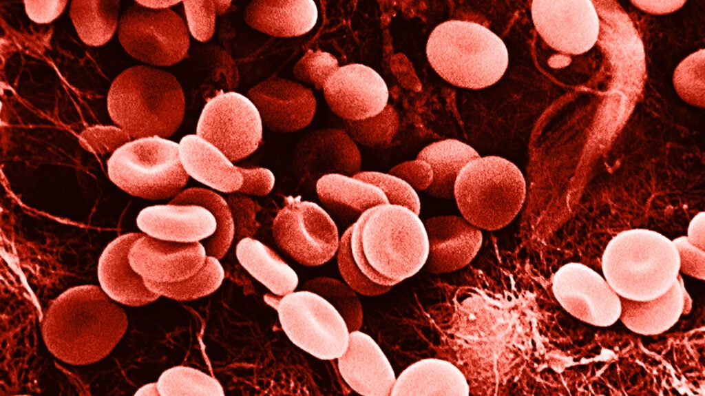 https://post.medicalnewstoday.com/wp-content/uploads/sites/3/2021/10/red-blood-cell-disorders-header-1024x575.jpg