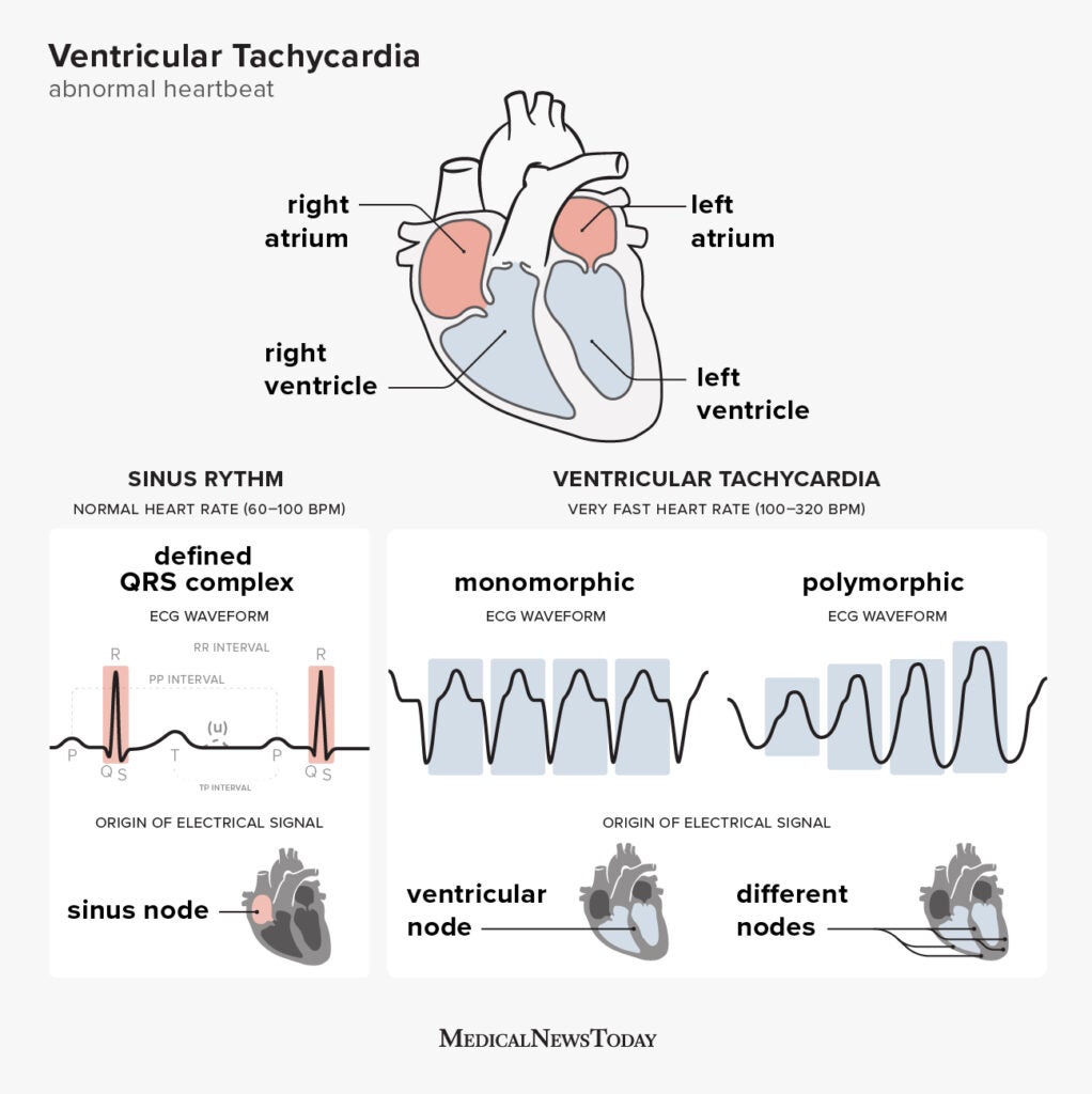 Ventricular Tachycardia 370 Ventricular Tachycardia Stock Photos 