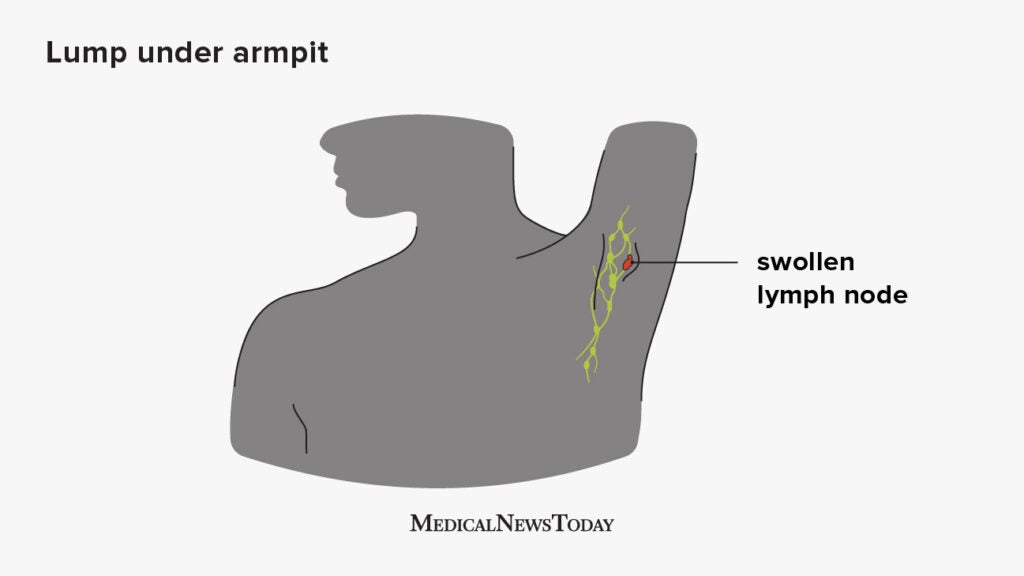 Swollen lymph nodes in armpit Symptoms causes and treatment