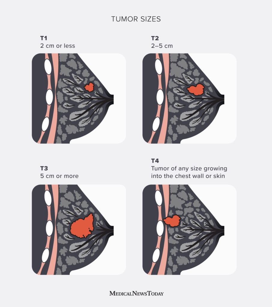 Breast cancer tumor size chart: Factors and more